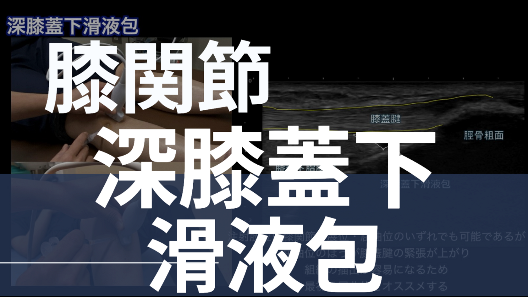 08-012 深膝蓋下滑液包(下崎研吾2026/1ver.)